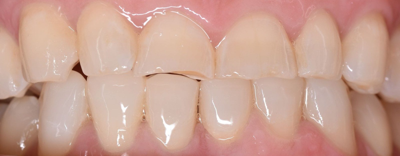 Before and after treatment at Argo Dental Clinic